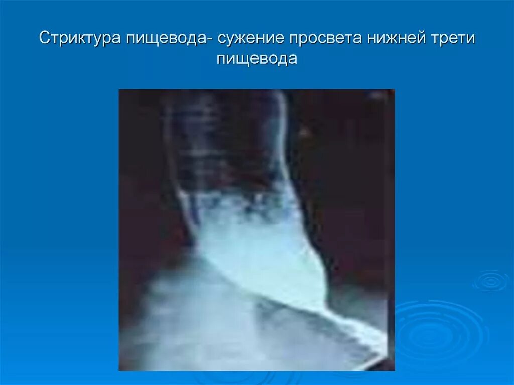 Просвет пищевода. Сужение просвета пищевода на рентгене. Рубцовые стриктуры пищевода. Рубцовое сужение пищевода рентген. Рубцовый стеноз пищевода.