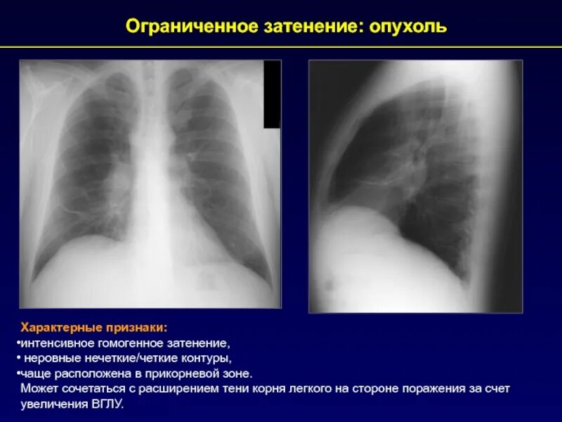 Опухоль лёгких симптомы. Синдром ограниченного затенения. Опухоль в легком контуры. Образование в легких что это может быть