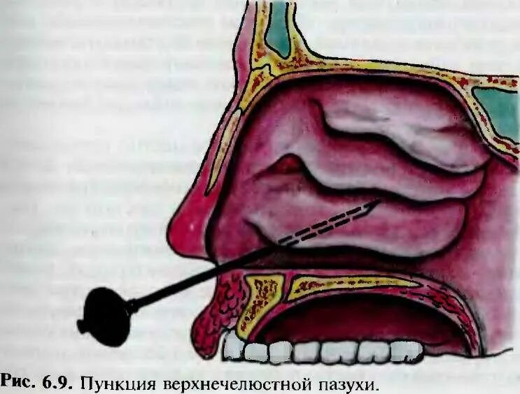 Пункция гайморовой пазухи. Соустье гайморовой пазухи. Прокол (пункция) гайморовой пазухи. Гайморит прокол гайморовой пазухи.