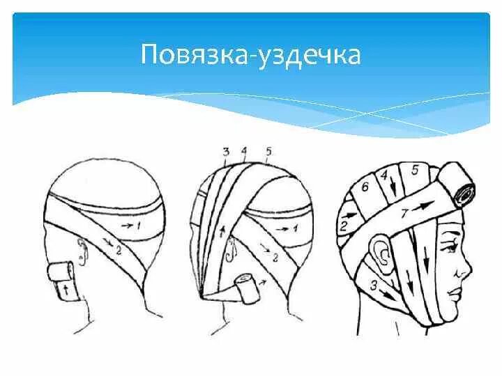 Повязка уздечка техника наложения. Десмургия повязка уздечка. Наложение повязки уздечка алгоритм. Наложение повязки на голову уздечка. Повязка уздечка накладывается