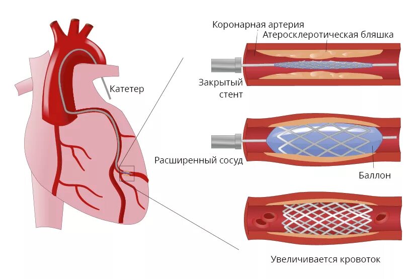 Шунтирующие сосуды. Стентирование коронарных артерий сердца. Стентировние корнараеыц атерии. Операция стентирование сосудов сердца. Коронарных сосудов после стентов.