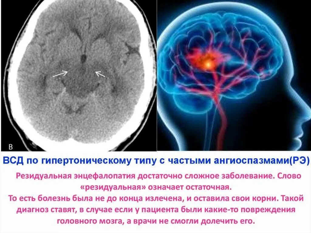 Резидуальные изменения головного мозга. Энцефалопатия головного мозга что это такое. Резидуальная энцефалопатия. Симптомы резидуальной энцефалопатии. Вегето сосудистая дистония головного мозга.