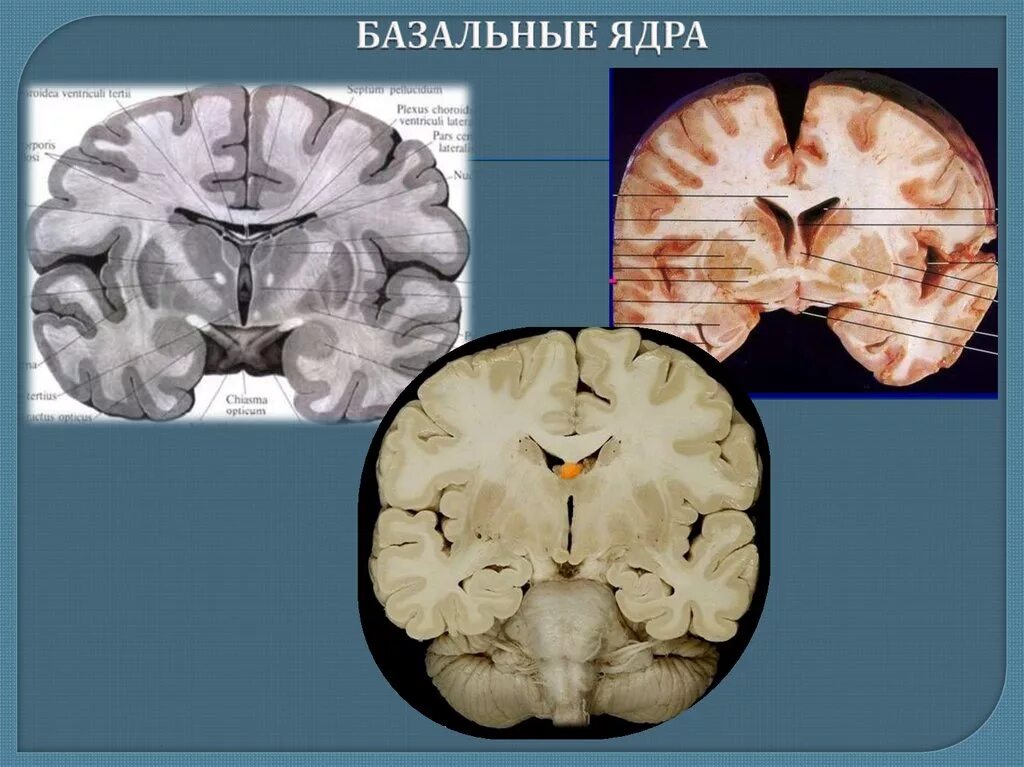 Усиленный в базальных отделах. Базальные (подкорковые) ядра конечного мозга. Важнейшие подкорковые базальные ядра. Базальные ядра анатомия. Скорлупа базальные ядра.