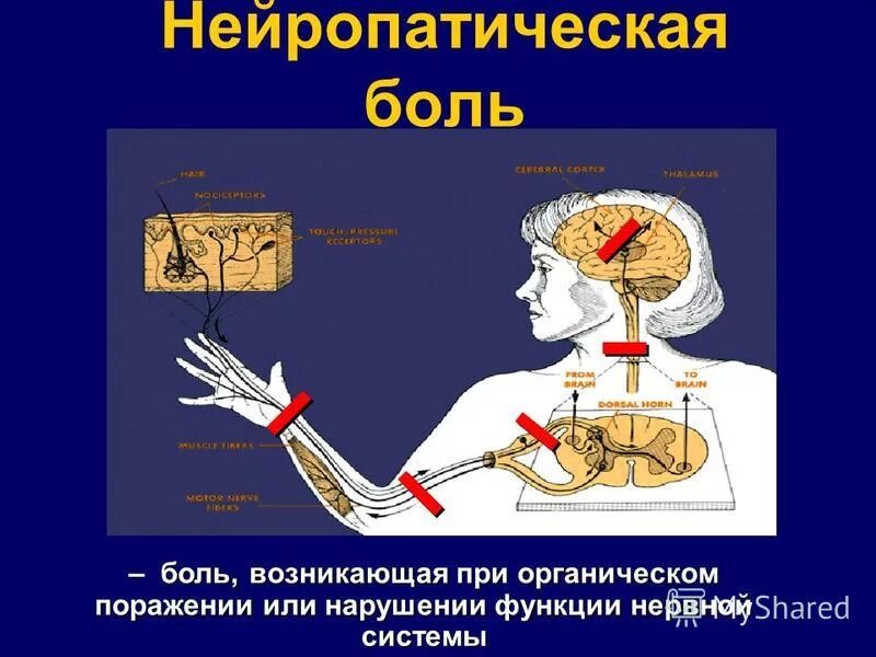 Нейропатическая боль в спине. Нейропатическая боль. Нейролептическпя боль. Схема нейропатической боли. Патогенез нейропатической боли.