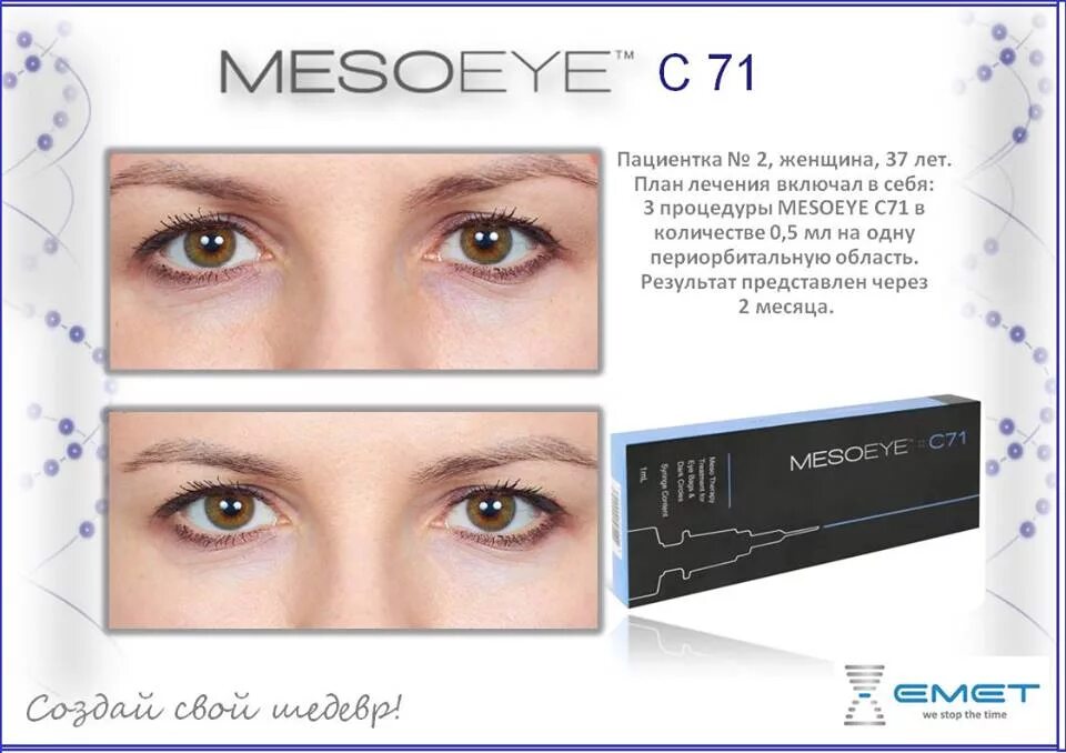 Препарат MESOEYE c71. Мезотерапия MESOEYE c71 для области глаз. МЕЗОАЙ С 71. Мезовартон МЕЗОАЙ. Мезая