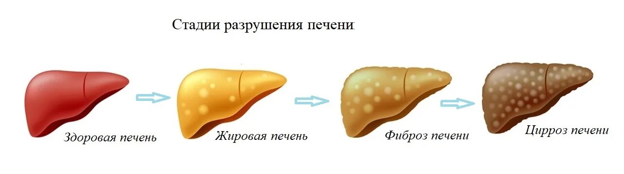 Жировое увеличение печени. Жировой гепатоз (стеатоз) печени. Гепатоз жировой гепатоз. Жировой гепатоз печени у животных. Жировой гепатоз симптомы.