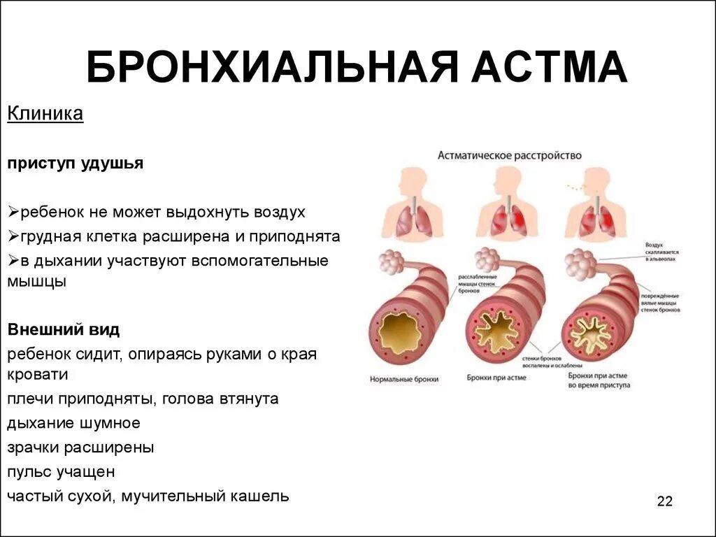 Бронхит лекция. Клиника бронхиальной астмы у детей. Приступ бронхиальной астмы клиника. Клиническая картина бронхиальной астмы у детей. Симптомы бронхиальной астмы кратко.