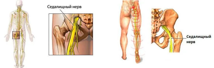 Воспаление сидальческого нерва. Невропатия седалищного нерва. Ранение седалищного нерва. Неврит седалищного нерва упражнения.