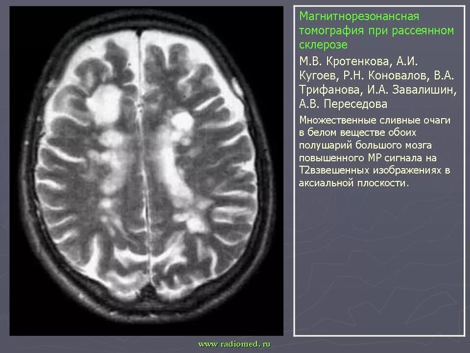 Склероз мозга. Мрт рассеянный склероз планинг. Рассеянный склероз множественные очаги. Рассеянный склероз мозжечок мрт. Очаги при рассеянном склерозе мрт.