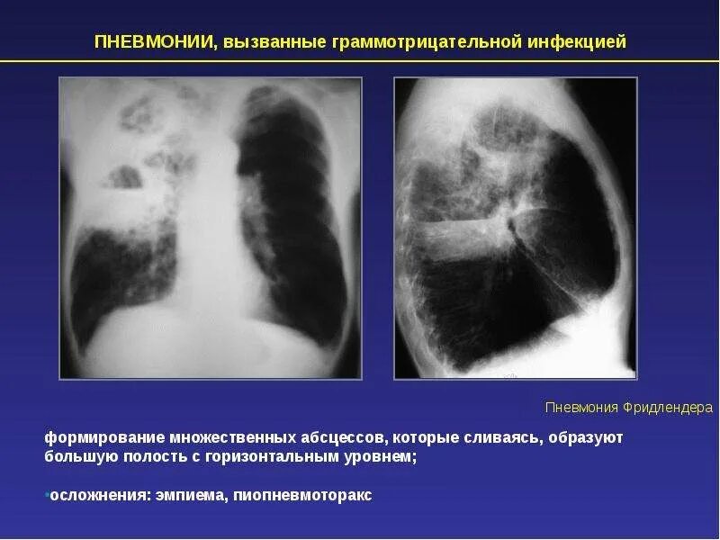 Крупозная и очаговая пневмония. Крупозная пневмония патан. Пневмония сгустки. Патогенез внебольничной пневмонии. Пневмония сгустки.