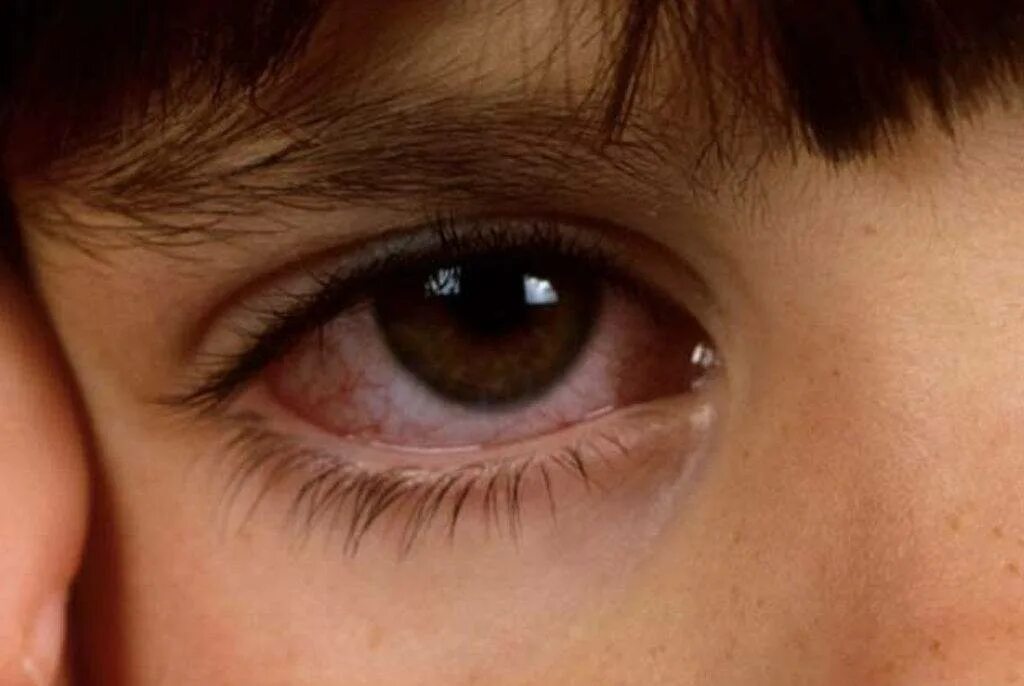 Катаральный аденовирусный конъюнктивит. Гиперемия коньюктивита. Гонобленнорейный конъюнктивит. Фликтенулёзный конъюнктивит. Красные глаза при орви у ребенка.