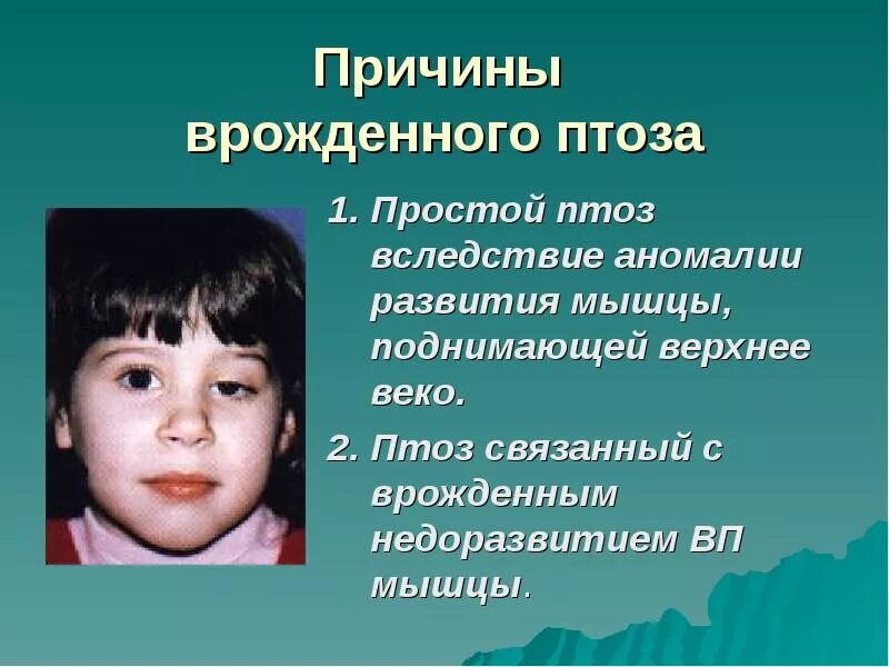 Врожденный птоз. Причины врожденного птоза. Врожденный птоз осложнения. Врожденный птоз верхнего века.