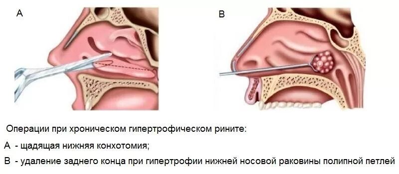 Лазер слизистой носа. Подслизистая вазотомия носовых. Конхотомия нижних носовых раковин. Эндоскопическая резекция средней носовой раковины что это. Эндоскопическая шейверная конхотомия.