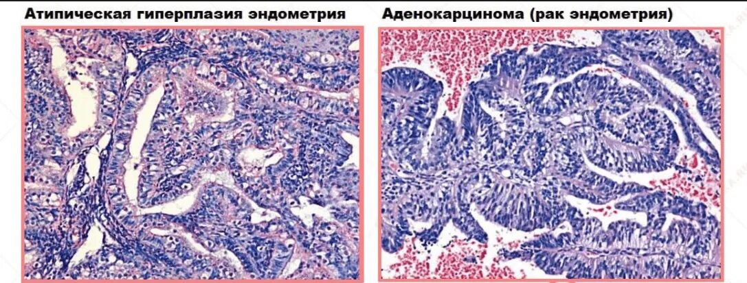 Рак матки препарат. Атипическая гиперплазия эндометрия гистология. Гиперплазия эндометрия гистология. Атипичная гиперплазия эндометрия матки гистология. Аденоматозный полип гистология.