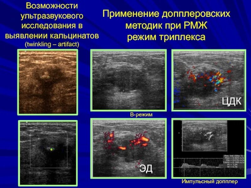 Кальцинаты в лимфоузлах. Кальцинат молочной железы на УЗИ. УЗИ молочных желез цветовое допплеровское картирование. Микрокальцинаты в молочной железе на УЗИ. Образования молочной железы на УЗИ.