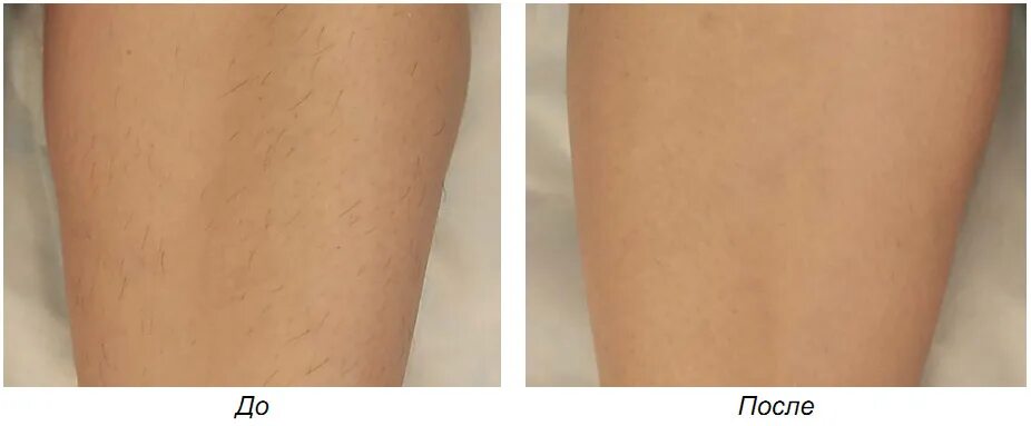 шугаринг глубокое бикини. депиляция. какие волосы после эпиляции. лазерная эпиляция. депиляция шугаринг.