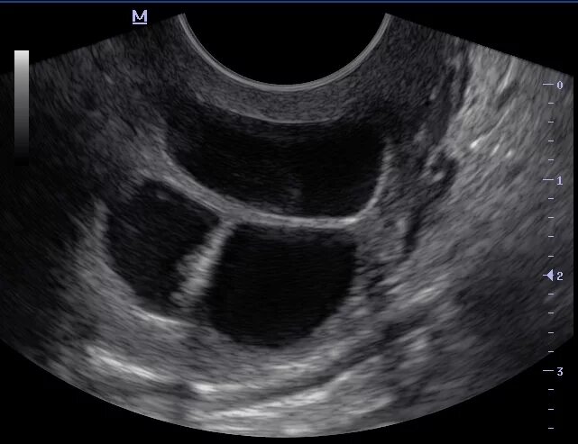 Эндометрий киста. Наботовы кисты на узи шейки матки. Шеечная беременность узи картина. Поперечный срез матки узи. Узи картина полипа эндометрия.