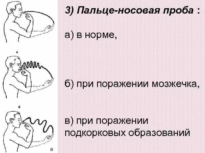 Тест мозжечок. Пальценосовая проба. Пальцево носовая проба. Проведение пальце-носовой пробы. Пальцепальцевая Рооба.