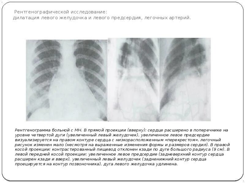 Дилатация правых отделов. Гипертрофия левого желудочка рентген. Гипертрофия левого предсердия рентген. Гипертрофия левого желудочка на рентгенограмме. Увеличение правого предсердия на рентгенограмме.