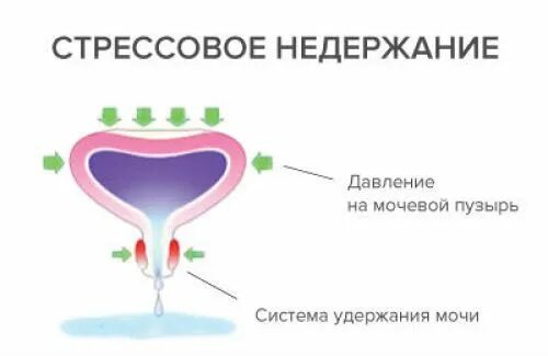 Выделяется моча у женщин. Недержание мочи у женщин мочевой пузырь. стрессовое недержание мочи. стрессовое недержание мочи у женщин. стрессовое недержание мочи у мужчин.