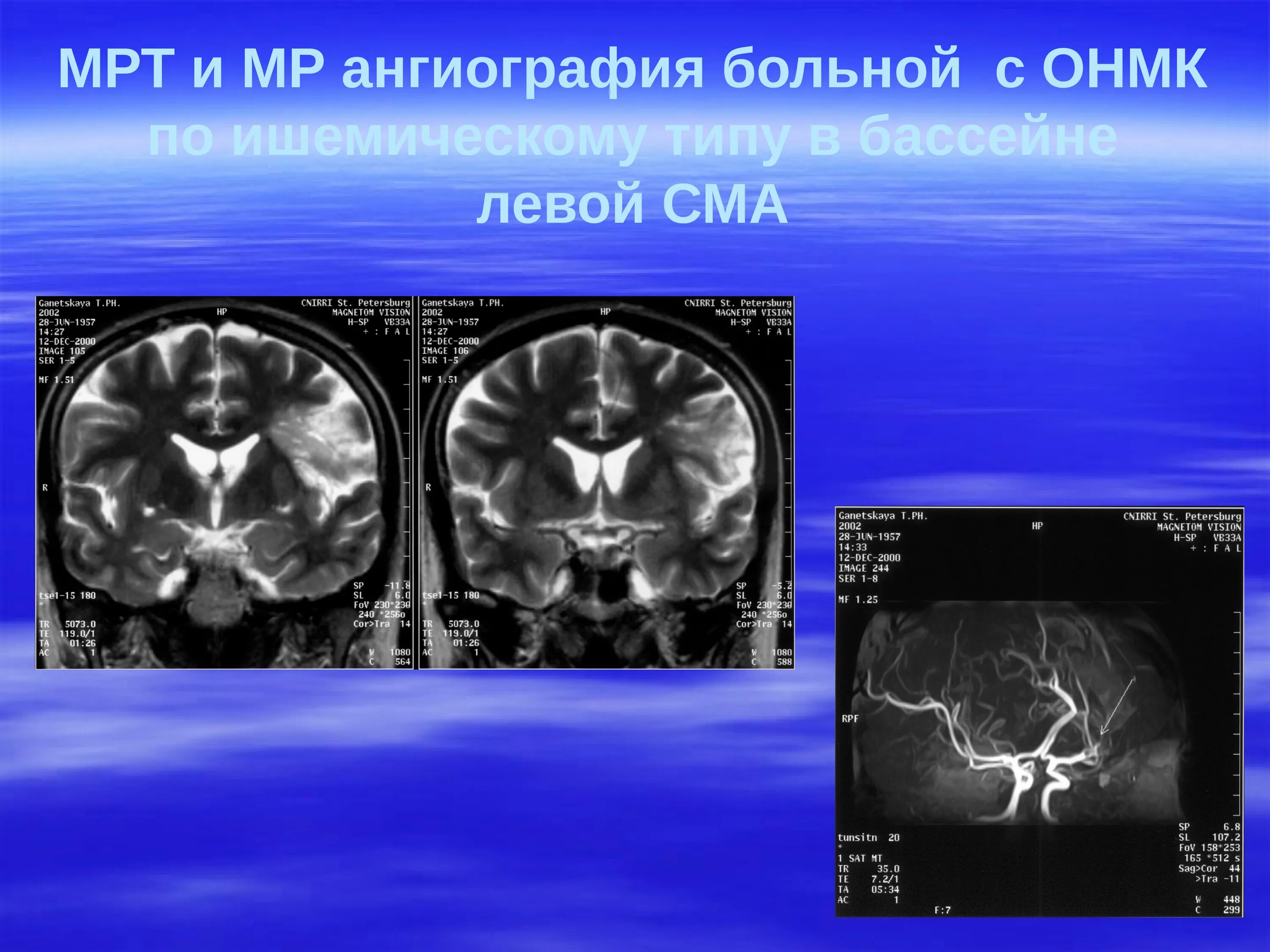 Левая средняя мозговая артерия инсульт. ОНМК В бассейне левой СМА. Ангиография в нейрохирургии. Ангиография сосудов головного мозга ОНМК.
