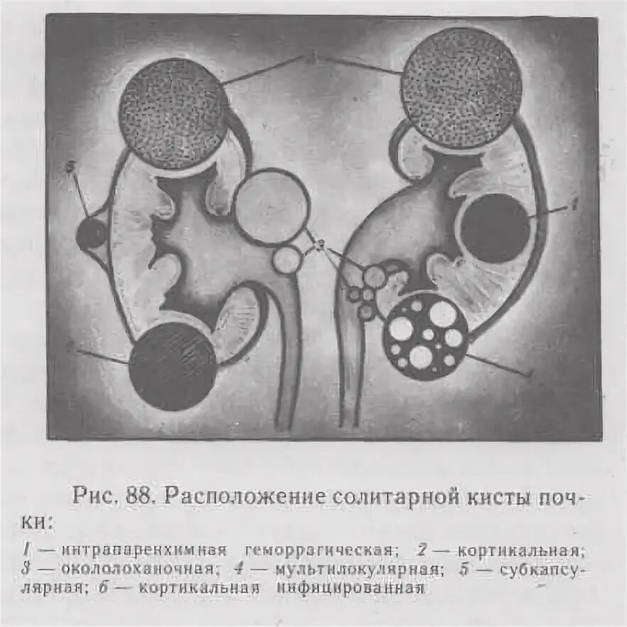 Солитарная киста почки. Солитарная киста почки препарат. Парапельвикальные кисты почек что это такое. Окололоханочная киста.