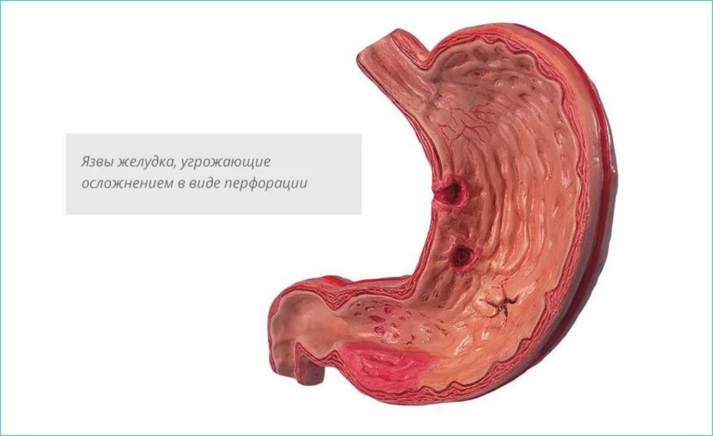 Гастродуоденит эрозивный бульбит. Эзофагит.эритематозная гастродуоденопатия. Антральный отдел желудка гастрит. Слизистая антрального отдела. Как быстро вылечить язву