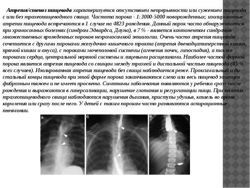 Пищевод у новорожденного