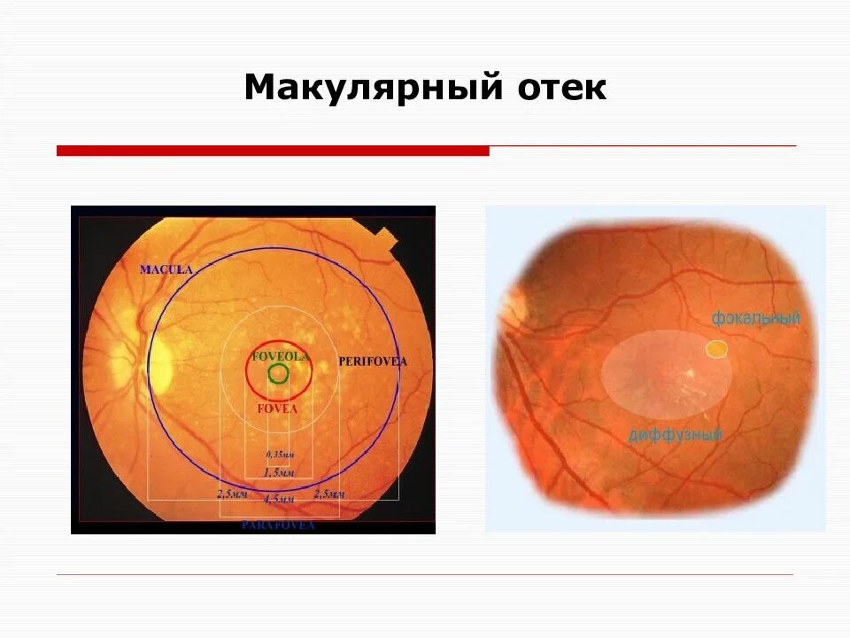 Макулярный отек лечение. Макулопатия макулярный отек. Окт макулярный отек сетчатки. Диабетический макулярный отек сетчатки. Отек в макулярной зоне сетчатки.