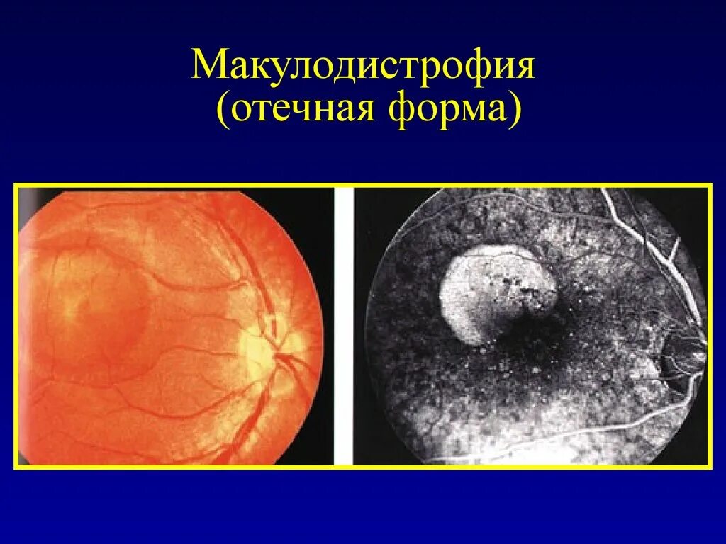 Лечение сухой макулодистрофии