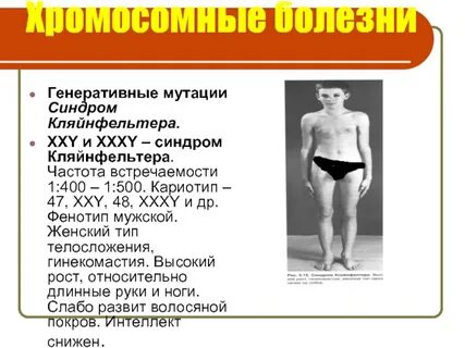 Кариотип 47 хху