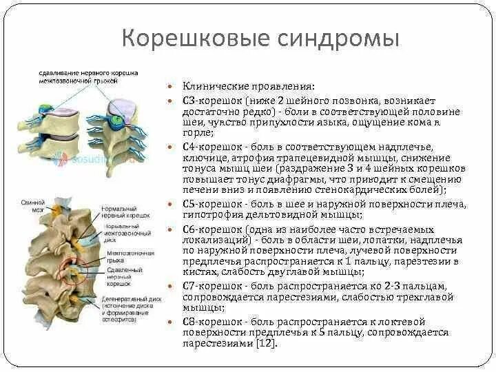 Шейный корешковый синдром. Корешок с1 поясничного отдела позвоночника. Корешковый синдром поясничного крестцового отдела. Шейный остеохондроз симптомы при корешковом синдроме.