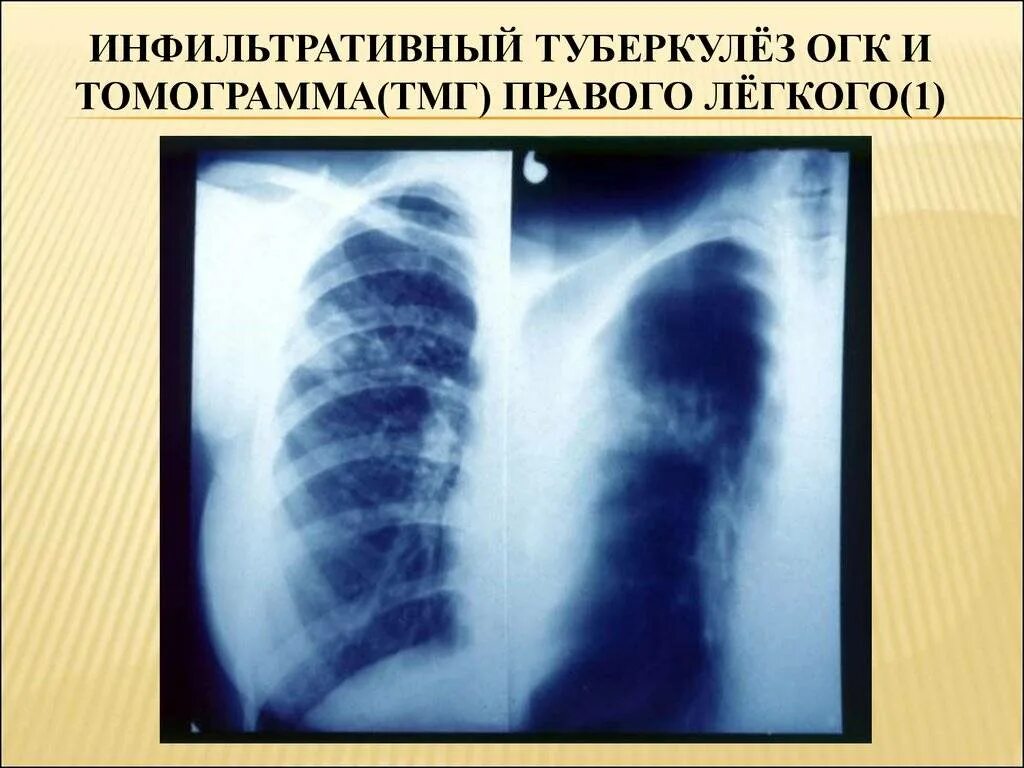 Изменение в верхнем легком. 1. Инфильтративный туберкулез. Инфильтративный туберкулез томограмма. Очаговый туберкулез инфильтрации. Инфильтративный туберкулез рентгенография.