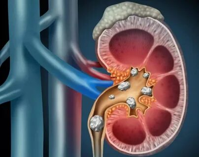 Оксалаты в почках