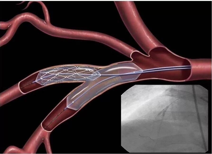 Стенты для сосудов. Баллонная ангиопластика сосудов. Коронарная ангиопластика и стентирование. Операция стентирование сосудов сердца. ТРАНСЛЮМИНАЛЬНАЯ баллонная коронарная ангиопластика.