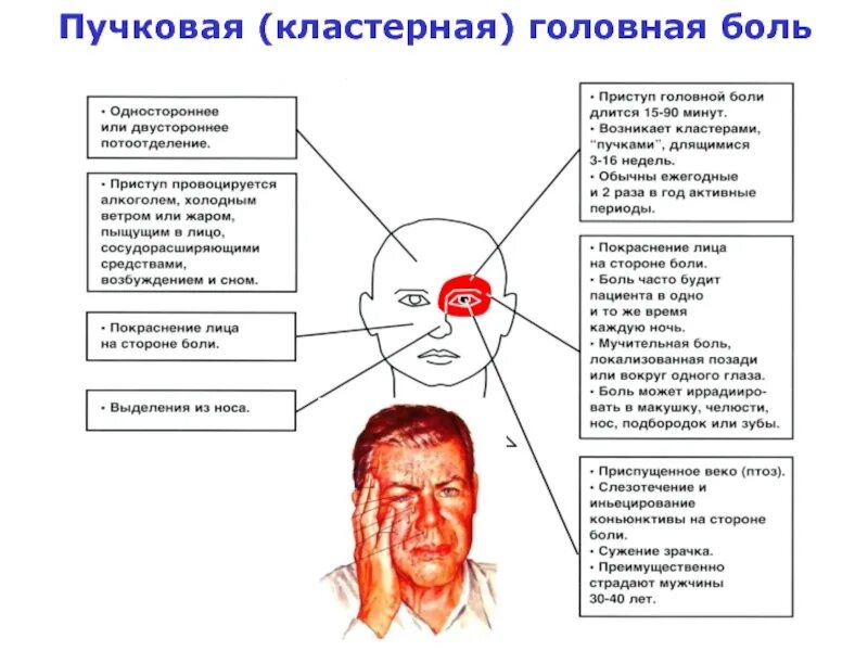 Сильная пульсирующая головная. Пучковая головная боль патогенез. Кластерная головная боль причины. Пучковая головная боль причины. Кластерная головная боль неврология.