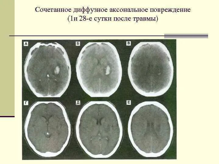 Диффузная травма мозга. Диффузное аксональное повреждение кт. Диффузное аксональное повреждение головного мозга кт. Диффузное аксональное повреждение мрт. Диффузные аксональные повреждения головного мозга мрт.