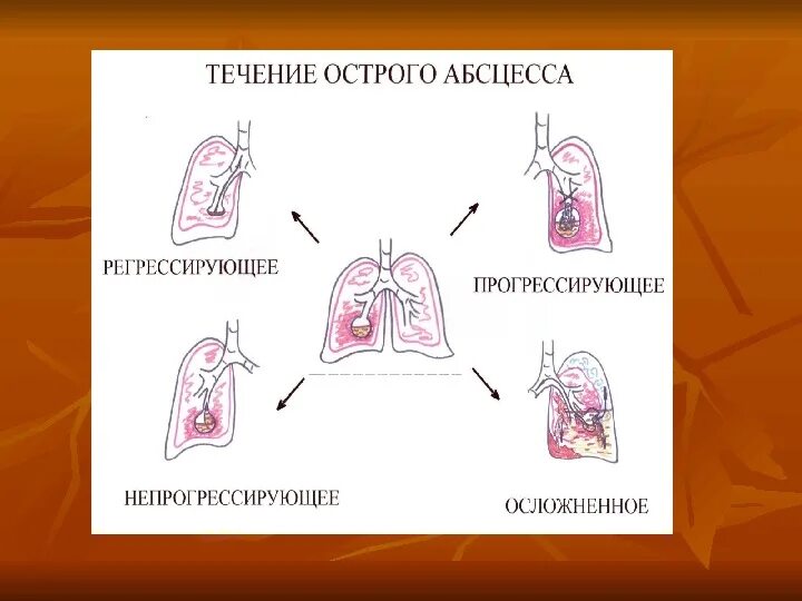 Абсцесс и гангрена легкого. Абсцесс лёгкого и гангрена. Абсцесс и гангрена легкого презентация. Гангрена легкого классификация. Гангрена легких презентация.