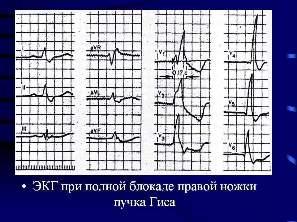 Экг полная блокада правой ножки пучка. Блокада правой ножки пучка гиса на экг что это на экг. Полная блокада правой ножки п. Блокада правой ножки пучка гиса на экг. Полная блокада пнпг.