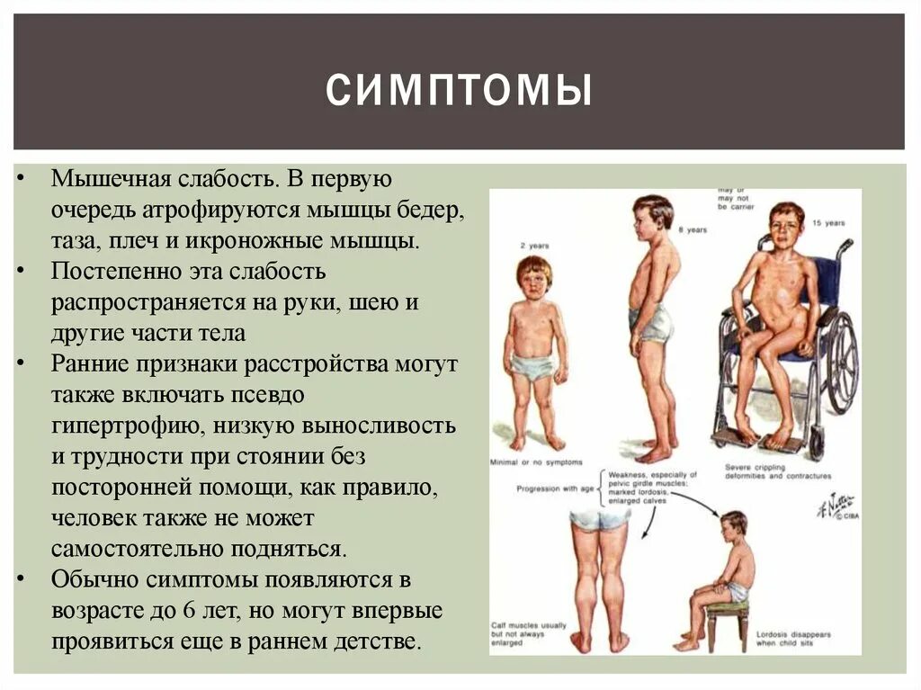 Мышечная слабость симптомы. Ослабление мышц.