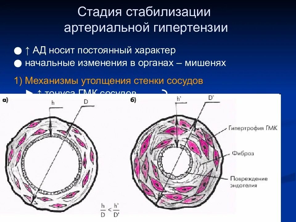 Схема изменений сосудистой стенки при гипертонической болезни. Изменения сосудов при гипертонической болезни. Стадия стабилизации артериальной гипертензии. Сосуды при артериальной гипертензии.