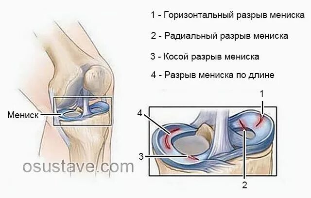 Разрыв мениска коленного сустава рентген. Передний Рог медиального мениска. Разрыв медиального мениска коленного сустава рентген. Разрыв мениска рентгеновском снимке.