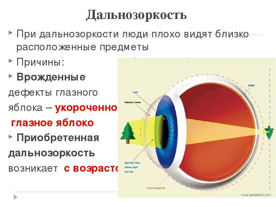 Причины возникновения дальнозоркости. Дальнозоркость. Причины дальнозоркости. Дальнозоркость презентация. Гиперметропия причины возникновения.