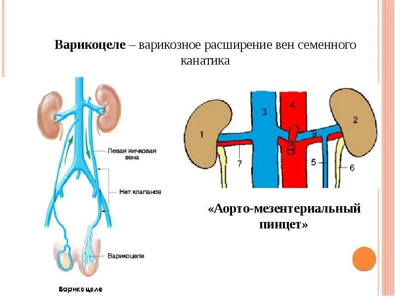 Венозное сплетение яичка. Аорто мезентериальный пинцет левой почечной вены. Варикоцеле мезентериальный пинцет. Синдром аорто-мезентериального пинцета. Варикозное расширение вен семенного канатика яичка..