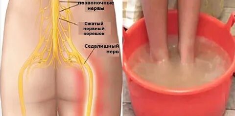 Лечение седалищного нерва после укола
