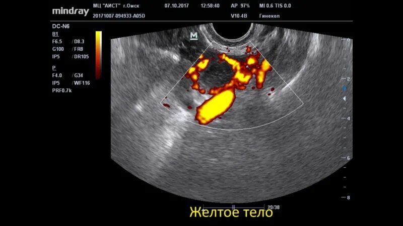 Желтое тело тянет яичник: найдено 90 картинок