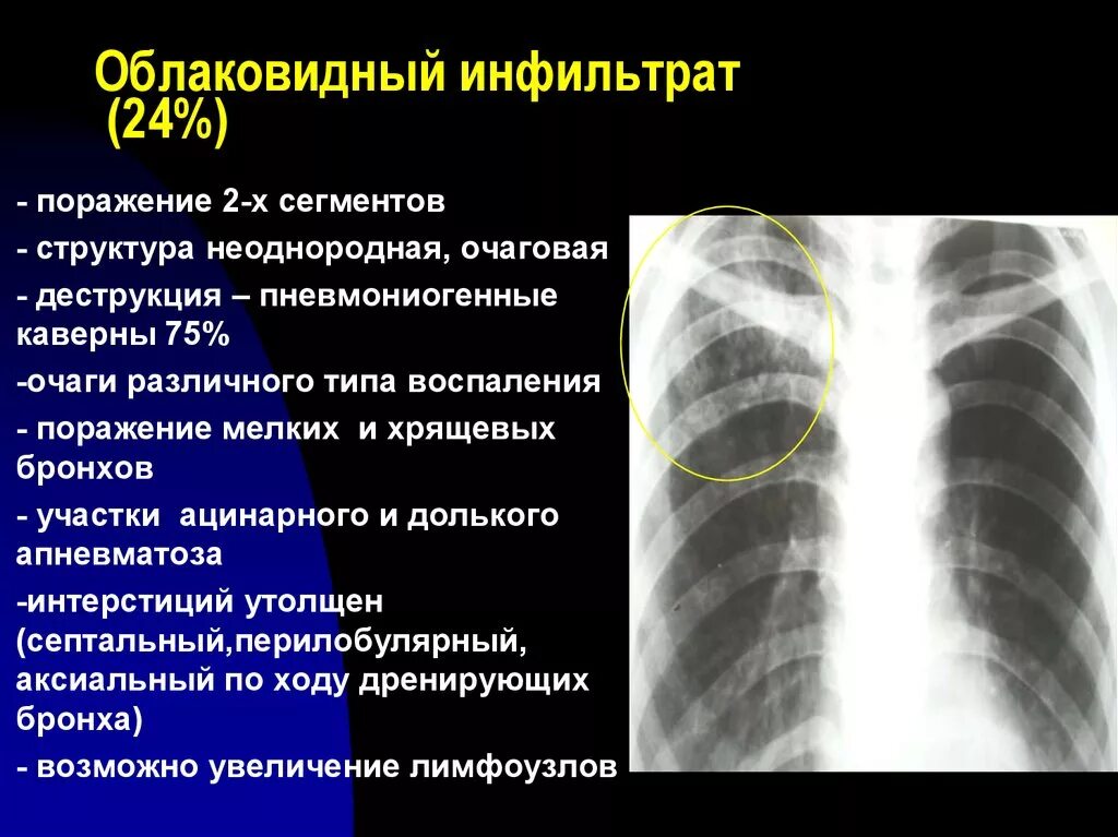 Округлый инфильтрат