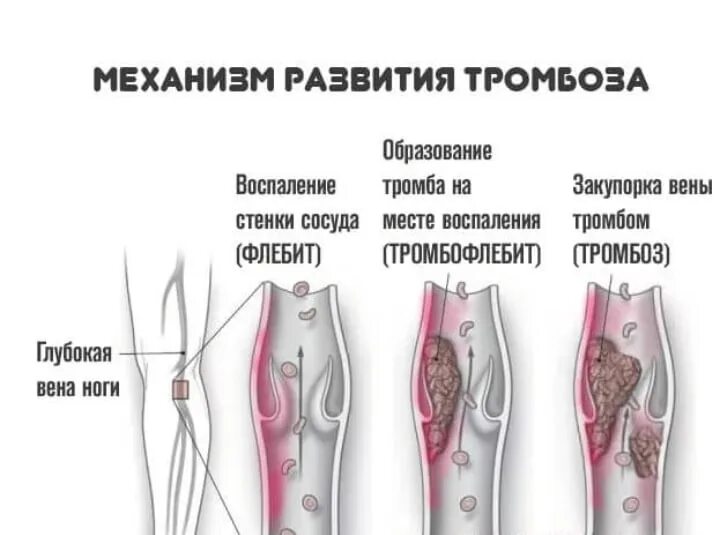 Чем отличается тромб