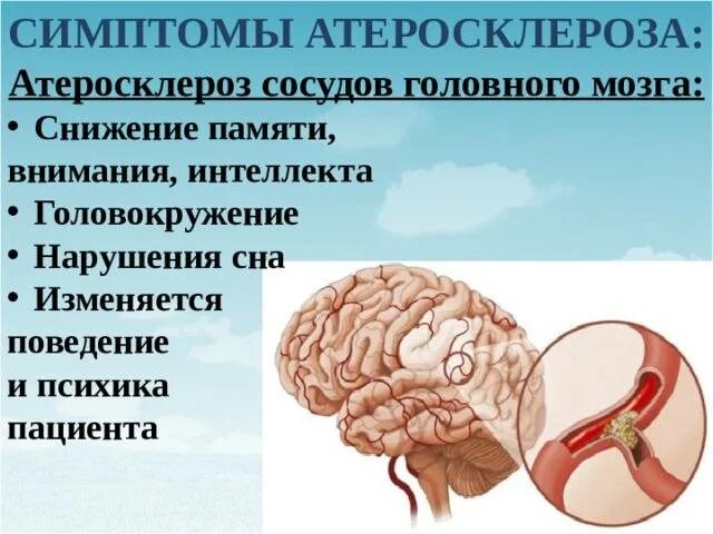 Лечение церебрального атеросклероза сосудов головного. Клинические проявления атеросклероза артерий головного мозга. Основной симптом при атеросклерозе артерий головного мозга. Атеросклеротическое поражение сосудов головного мозга. Атеросклероз сосудов головного МОЗ.