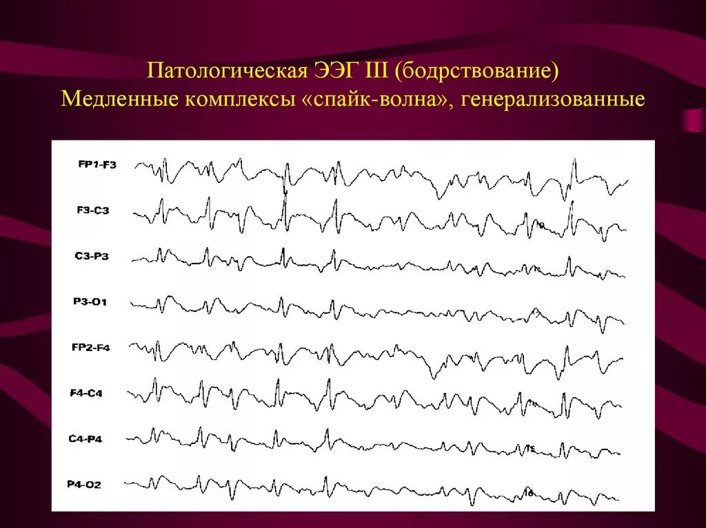 Пароксизмальная активность на ЭЭГ. Эпилептиформная активность на ЭЭГ. Патологическая ЭЭГ бодрствование. Патологические ритмы ЭЭГ при эпилепсии.